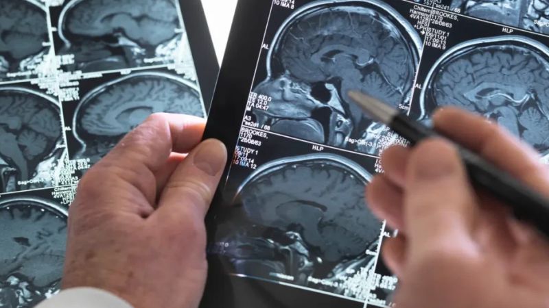 Día Mundial del ACV: las 5 señales de alerta que hay que reconocer a tiempo